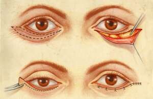 incisions blépharoplastie inférieure