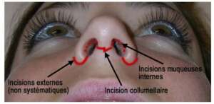 incisions chirurgie esthétique du nez