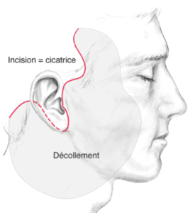 décollement lifting du visage