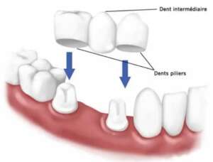 Ciment dentaire : pour fixer de façon durable vos couronnes, bridges
